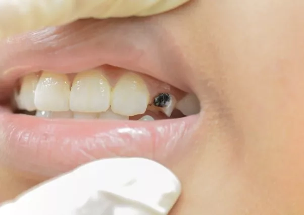 Young patient with a tooth decay